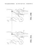 HIP SURGERY SYSTEMS AND METHODS diagram and image