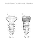 Aiming Arm for Bone Plates diagram and image