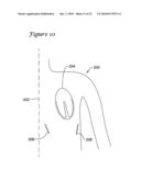 Apparatus and Method for Subcutaneous Electrode Insertion diagram and image