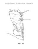 DEVICES, SYSTEMS AND METHODS FOR TISSUE REPAIR diagram and image