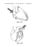 DEVICES, SYSTEMS AND METHODS FOR TISSUE REPAIR diagram and image