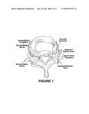 Injection of fibrin sealant including an anesthetic in spinal applications diagram and image