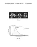 HISTOGRAM-BASED ANALYSIS METHOD FOR THE DETECTION AND DIAGNOSIS OF NEURODEGENERATIVE DISEASES diagram and image