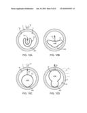 DUAL MODULUS BALLOON FOR INTERVENTIONAL PROCEDURES diagram and image