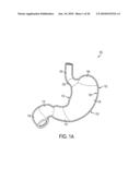 GASTRIC RESTRICTION DEVICES WITH FILLABLE CHAMBERS AND ABLATION MEANS FOR TREATING OBESITY diagram and image