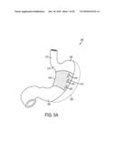 GASTRIC RESTRICTION DEVICES WITH FILLABLE CHAMBERS AND ABLATION MEANS FOR TREATING OBESITY diagram and image