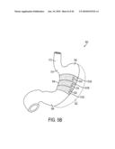 GASTRIC RESTRICTION DEVICES WITH FILLABLE CHAMBERS AND ABLATION MEANS FOR TREATING OBESITY diagram and image