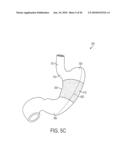 GASTRIC RESTRICTION DEVICES WITH FILLABLE CHAMBERS AND ABLATION MEANS FOR TREATING OBESITY diagram and image