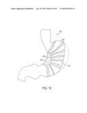 GASTRIC RESTRICTION DEVICES WITH FILLABLE CHAMBERS AND ABLATION MEANS FOR TREATING OBESITY diagram and image