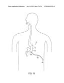 GASTRIC RESTRICTION DEVICES WITH FILLABLE CHAMBERS AND ABLATION MEANS FOR TREATING OBESITY diagram and image