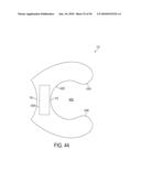 GASTRIC RESTRICTION DEVICES WITH FILLABLE CHAMBERS AND ABLATION MEANS FOR TREATING OBESITY diagram and image