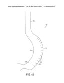 GASTRIC RESTRICTION DEVICES WITH FILLABLE CHAMBERS AND ABLATION MEANS FOR TREATING OBESITY diagram and image