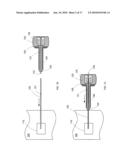 Introducer Tool for Bone Measurement diagram and image