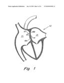 TUBULAR PATENT FORAMEN OVALE (PFO) CLOSURE DEVICE WITH CATCH SYSTEM diagram and image