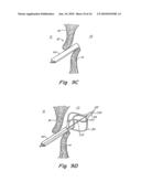 TUBULAR PATENT FORAMEN OVALE (PFO) CLOSURE DEVICE WITH CATCH SYSTEM diagram and image