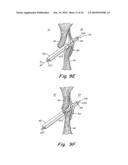 TUBULAR PATENT FORAMEN OVALE (PFO) CLOSURE DEVICE WITH CATCH SYSTEM diagram and image