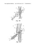 TUBULAR PATENT FORAMEN OVALE (PFO) CLOSURE DEVICE WITH CATCH SYSTEM diagram and image