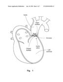 PROSTHETIC VALVLE FOR INTRALUMINAL IMPLANTATION diagram and image