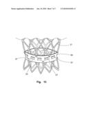 PROSTHETIC VALVLE FOR INTRALUMINAL IMPLANTATION diagram and image