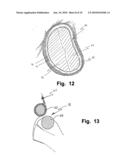 Device And Method For Improving Function Of Heart Valve diagram and image