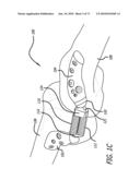 ADJUSTABLE ABSORBER DESIGNS FOR IMPLANTABLE DEVICE diagram and image