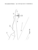 INFLATABLE MEDICAL DEVICES diagram and image