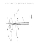 INFLATABLE MEDICAL DEVICES diagram and image