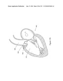 INFLATABLE MEDICAL DEVICES diagram and image