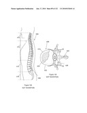 INFLATABLE MEDICAL DEVICES diagram and image