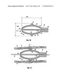 METHOD FOR DELIVERING MEDICATION INTO AN ARTERIAL WALL FOR PREVENTION OF RESTENOSIS diagram and image