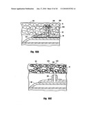 METHOD FOR DELIVERING MEDICATION INTO AN ARTERIAL WALL FOR PREVENTION OF RESTENOSIS diagram and image