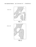 HEAD CENTERING JIG FOR FEMORAL RESURFACING diagram and image