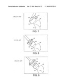 HEAD CENTERING JIG FOR FEMORAL RESURFACING diagram and image