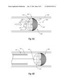 BODY LUMEN FILTERS WITH STRUCTURES TO REDUCE PARTICULATES AND METHODS FOR FILTERING A BODY LUMEN diagram and image