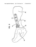 Universal Surgical Plate with 30 Degree Compression Angle diagram and image