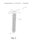 PEDICLE SCREW SYSTEM WITH PROVISIONAL LOCKING ASPECTS diagram and image