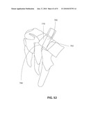 TRANSCORPOREAL SPINAL DECOMPRESSION AND REPAIR SYSTEMS AND RELATED METHODS diagram and image