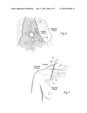 Systems and methods to place one or more leads in tissue for providing functional and/or therapeutic stimulation diagram and image