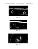 Intraluminar perforated radially expandable drug delivery prosthesis and a method for the production thereof diagram and image