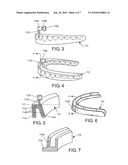 INTRA-ORAL APNEA AND SNORING PREVENTIONG APPLIANCE diagram and image