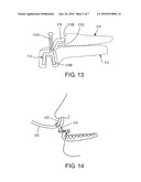 INTRA-ORAL APNEA AND SNORING PREVENTIONG APPLIANCE diagram and image