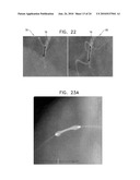 AUTOMATIC STABILIZATION OF AN IMAGE STREAM OF A MOVING ORGAN diagram and image