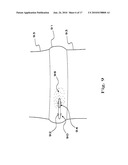 DRUG DEPOT IMPLANT DESIGNS AND METHODS OF IMPLANTATION diagram and image