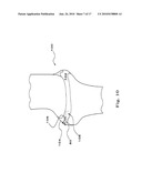 DRUG DEPOT IMPLANT DESIGNS AND METHODS OF IMPLANTATION diagram and image