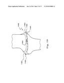 DRUG DEPOT IMPLANT DESIGNS AND METHODS OF IMPLANTATION diagram and image