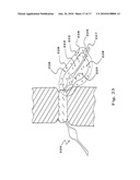 DRUG DEPOT IMPLANT DESIGNS AND METHODS OF IMPLANTATION diagram and image