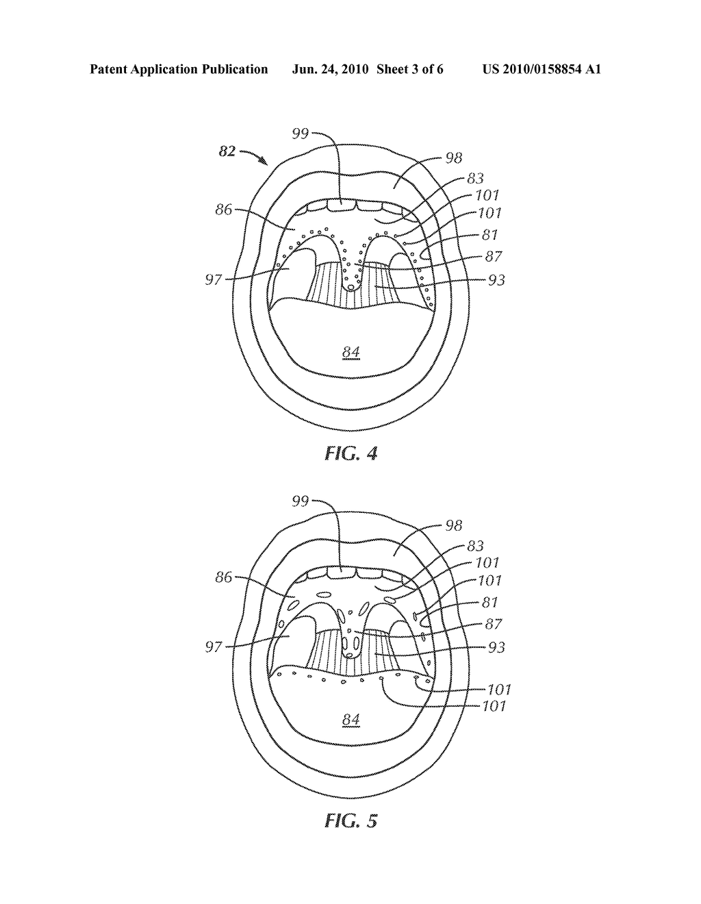 METHOD FOR TREATMENT OF AIRWAY AND APPARATUS AND KIT FOR USE THEREWITH - diagram, schematic, and image 04