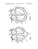 CARDIAC SUPPORT DEVICE WITH DIFFERENTIAL COMPLIANCE diagram and image