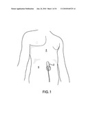 Methods and Devices for Endoscopic Access to the Heart diagram and image