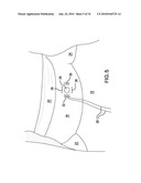 Methods and Devices for Endoscopic Access to the Heart diagram and image